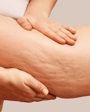 comment-enlever-la-cellulite-min
