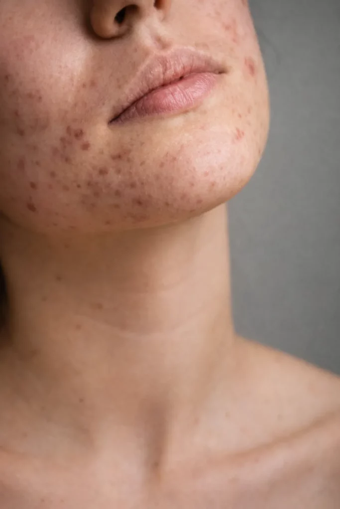 acne_hormonal_femme_oderma_clermont-ferrand